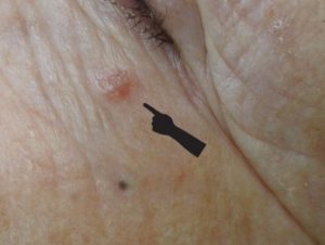 Carcinoma basocelular (3)