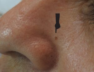 Carcinoma basocelular (4)