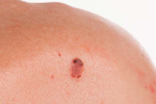carcinoma basocelular