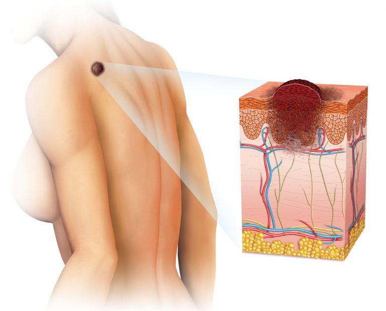 esquema melanoma
