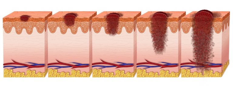 etapas del melanoma