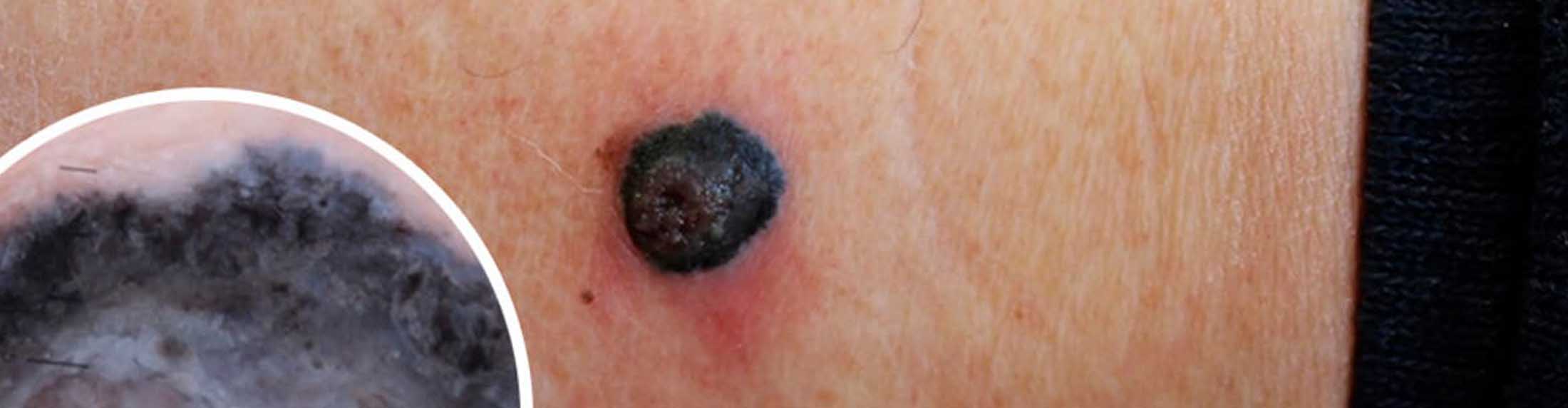 Melanoma Maligno Qué es y cómo tratarlo Dr. Schwartz