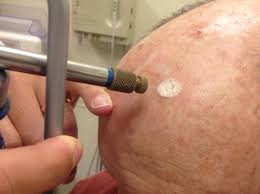 Tratamiento-de-lesiones-pre-cancerosas